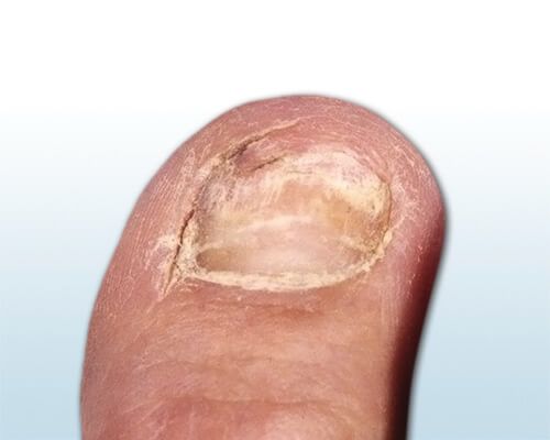 Bild zeigt gelb-weißliche Nagelverfärbung und abgebrochenen Nagelrand