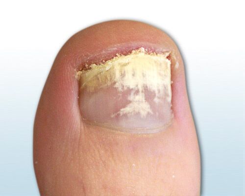 Bild zeigt Folgen von Nagelpilz am Fußnagel, in Form von gelb-weißer Nagelverfärbung und brüchiger Platte